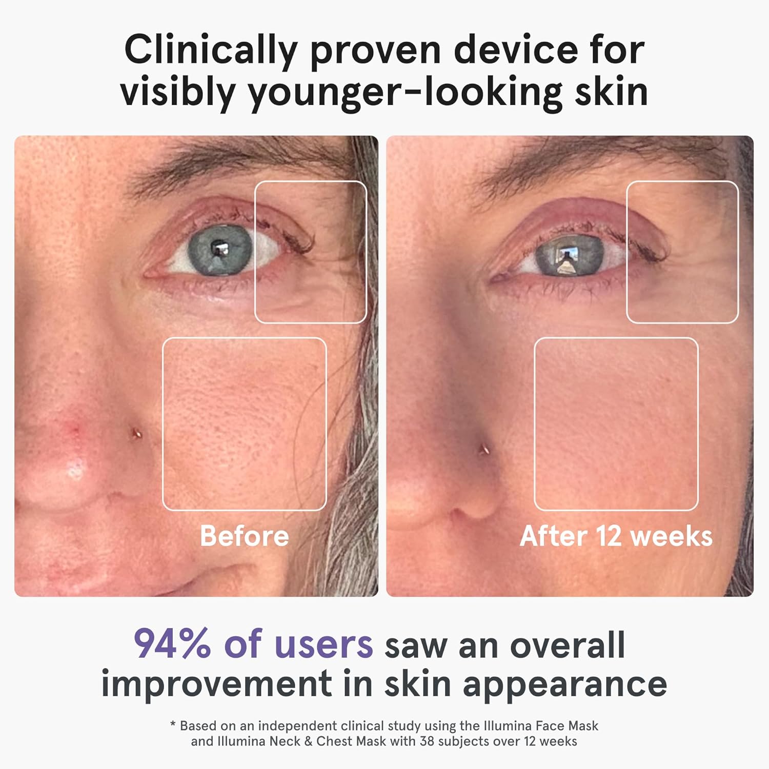 Before and after iRestore Illumina 12 weeks skin improvement